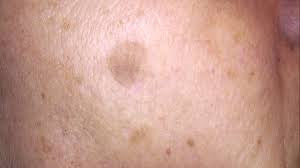 Solar Lentigo - Age Spots/Liver Spots
