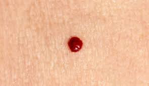 Cherry Angioma