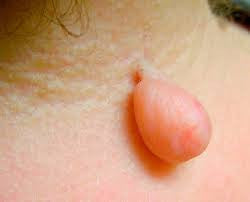 Skin Tag Removal